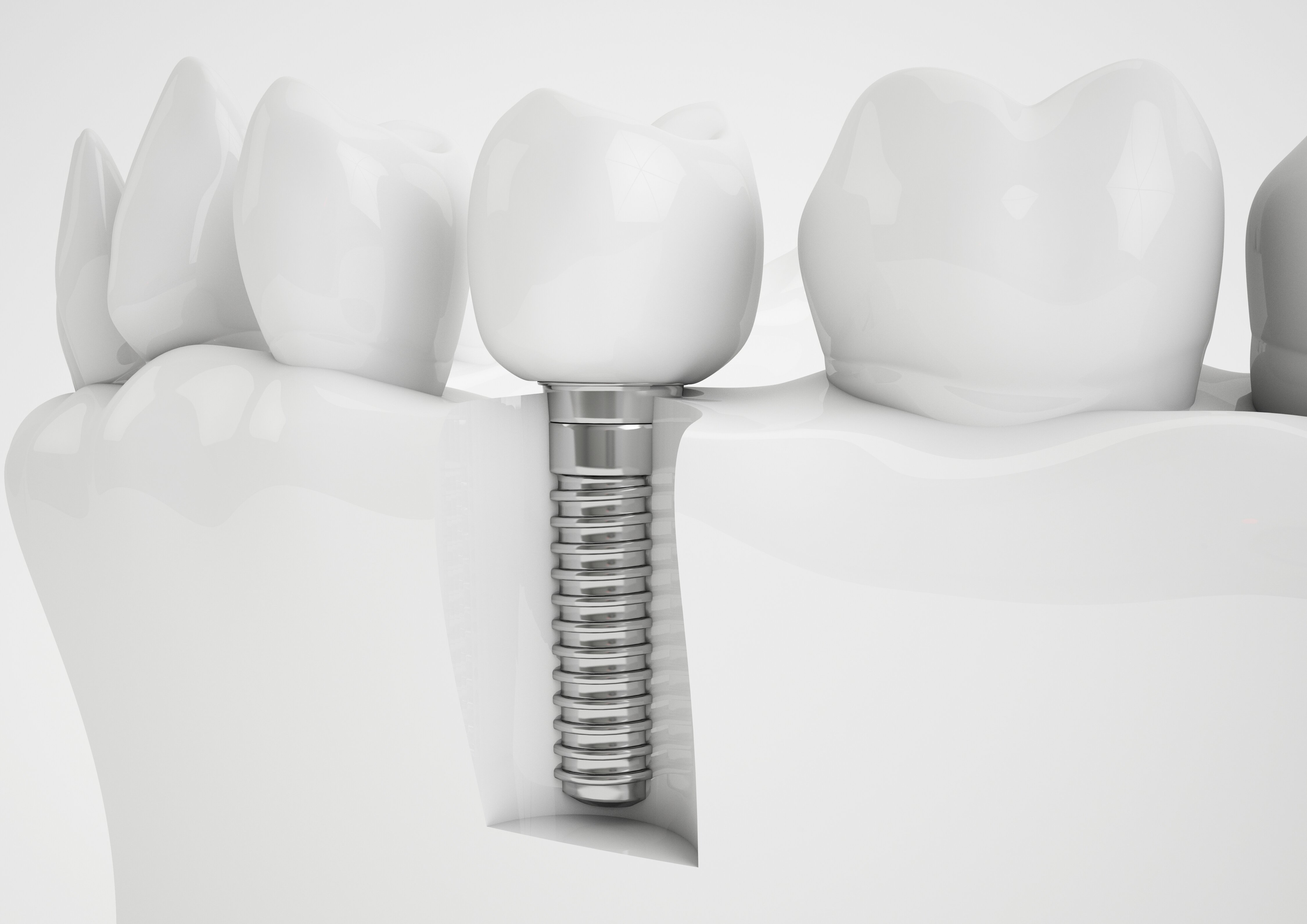 Concept of a dental implant