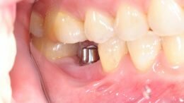 missing tooth implant
